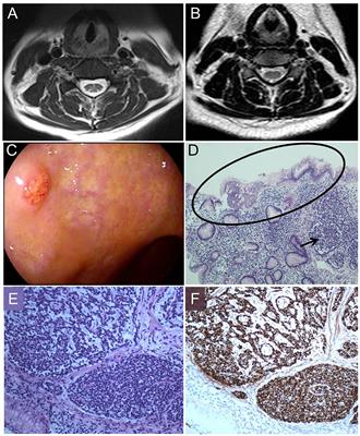 Subacute Combined Degeneration, Pernicious Anemia and Gastric Neuroendocrine Tumor Occured Simultaneously Caused by Autoimmune Gastritis